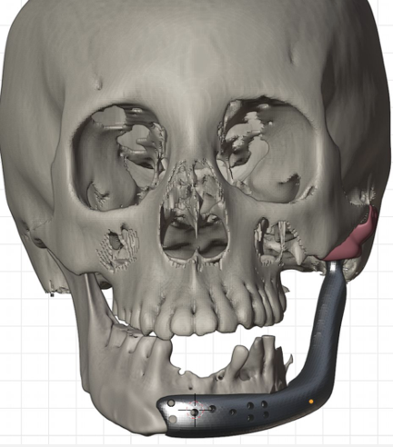 Vista frontal del diseño tridimensional de prótesis mandibular personalizada