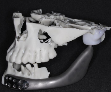 Modelo anatómico lateral con reconstrucción mandibular