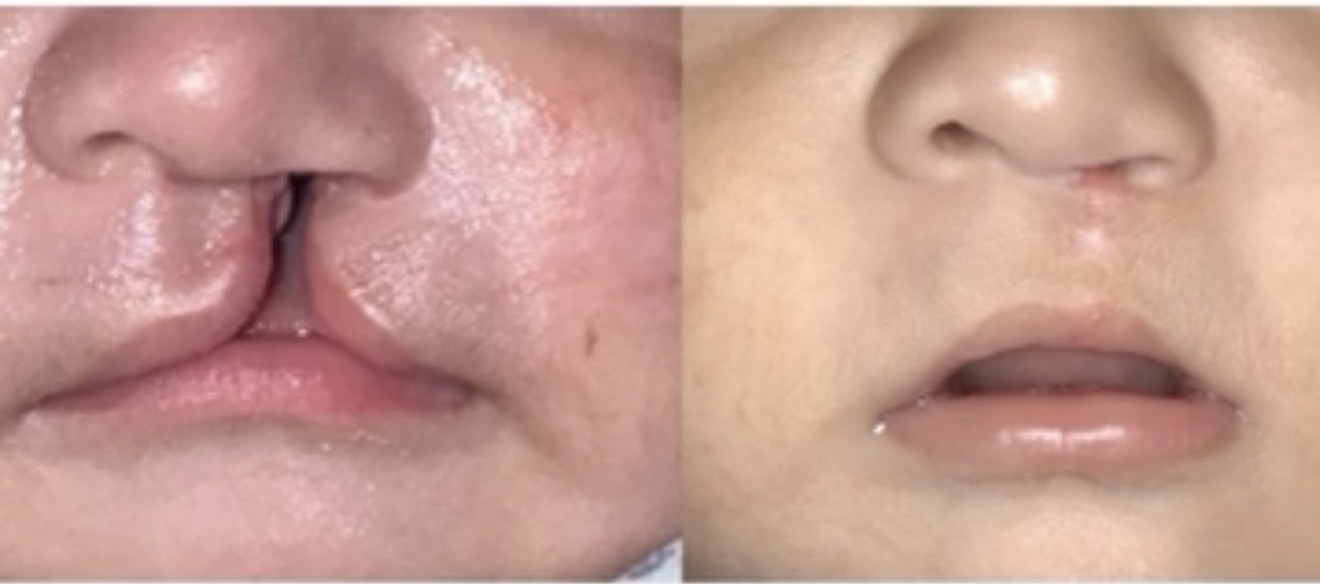 Comparación del labio hendido antes y después de la reparación quirúrgica
