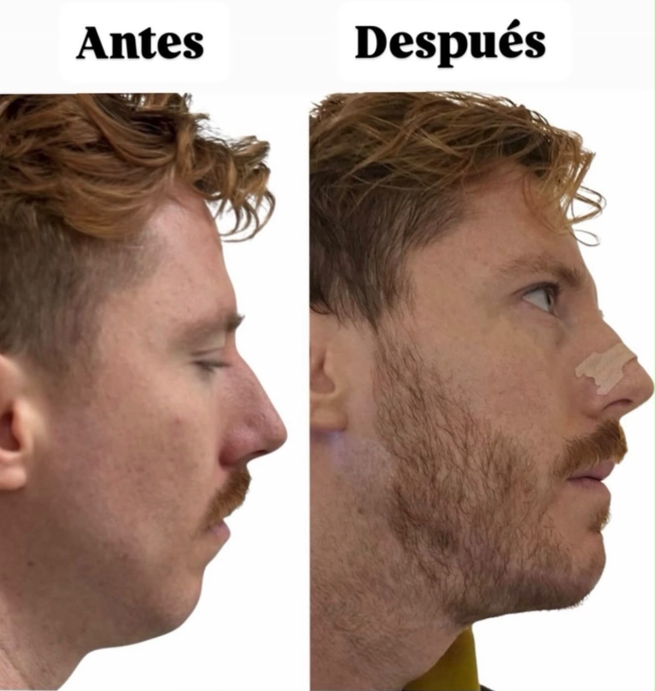 Perfil antes y después de mentoplastia ósea de avance