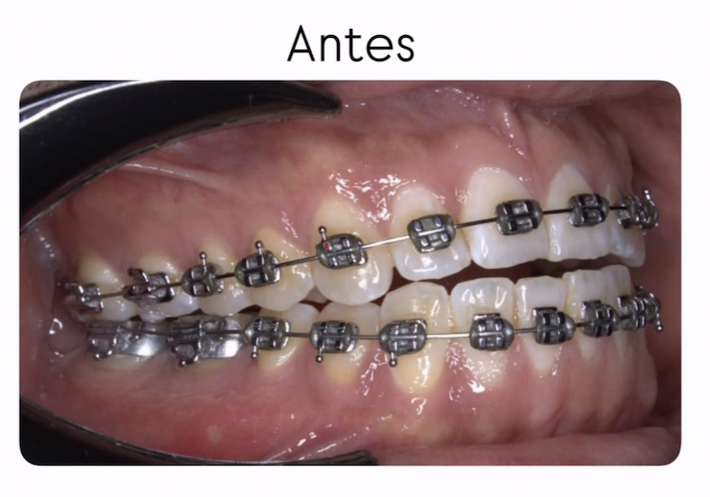 Oclusión lateral antes del tratamiento