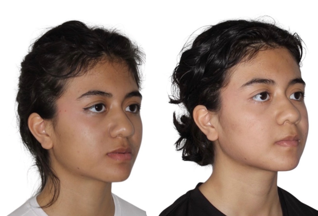 Comparación facial antes y después de cirugía ortognática