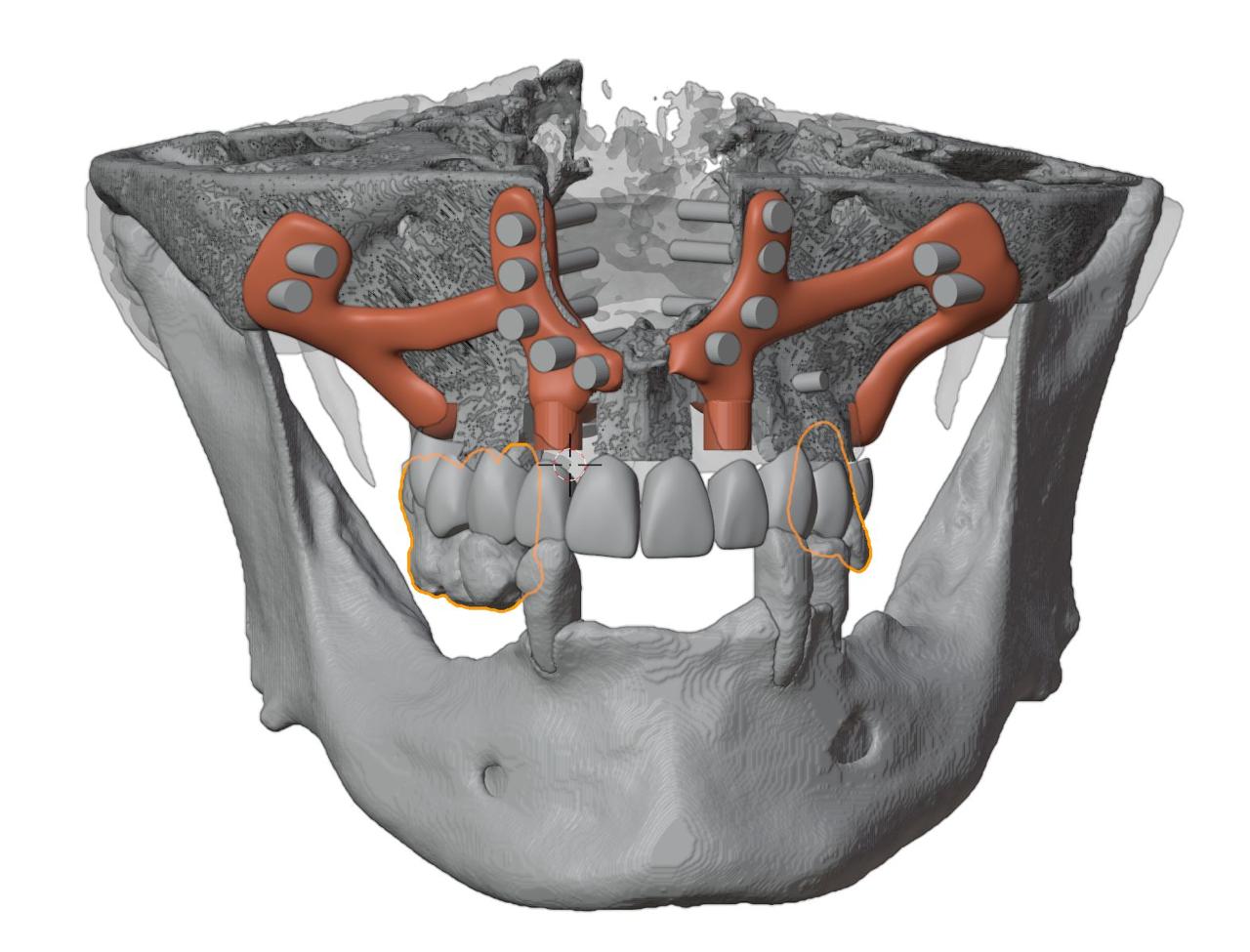 Diseño virtual personalizado de implantes subperiósticos sobre modelo tomográfico