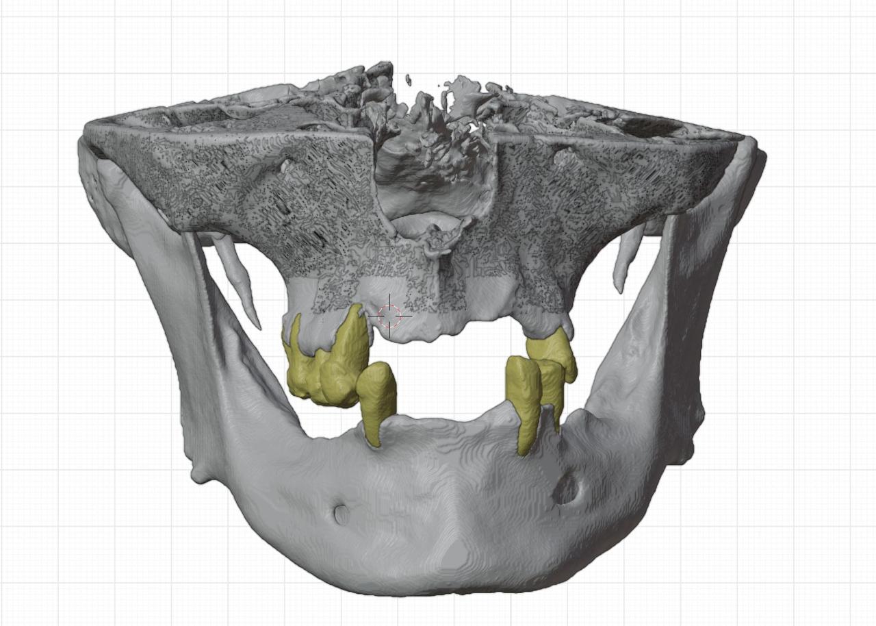 Modelo digital frontal de maxilar y mandíbula obtenido para planificación